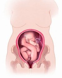 Беременность и роды при тазовом предлежании плода